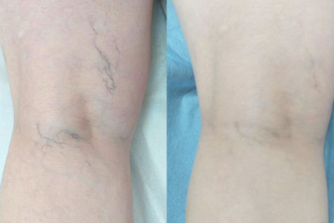 Сосудистые звездочки на ногах: косметическая проблема или начало варикоза