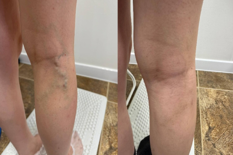 Результат лечения