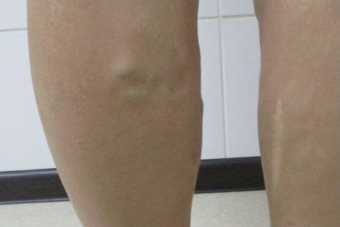 Лечение варикоза за один день - результат после ЭВЛК