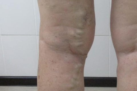 Лечение варикозных узлов на голени - результат после малоинвазивного вмешательства